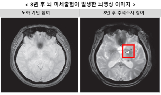 수면무호흡증, 뇌 미세출혈 위험 2배...